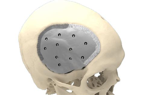 Cranioplasty Patient Concept Cadskills