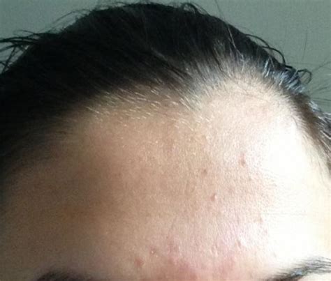 Acne Bumps Under Skin Forehead Feedtheking