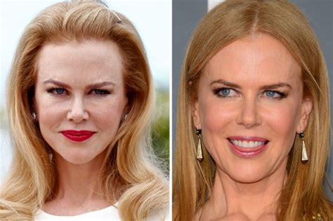Nicole Kidman Botox