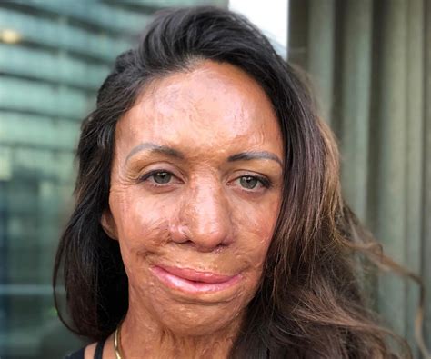 Turia Pitt Before The Fire That Burned Per Cent Of Her Body