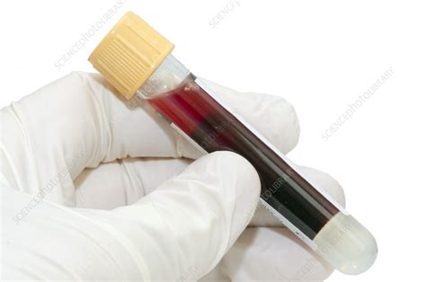 Blood Sample Stock Image C0167354 Science Photo Library