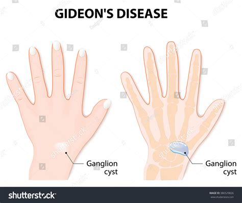 Ganglion Cyst Known Synovial Cyst Gideons Ilustrações Stock 386529826 Shutterstock