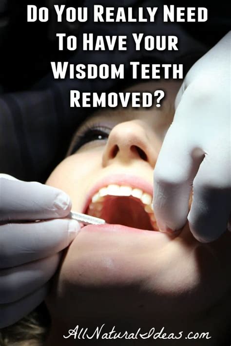 Went to an oral surgeon and received iv sedation for the removal of 4 wisdom teeth. Do you have to get your wisdom teeth removed? | All Natural Ideas