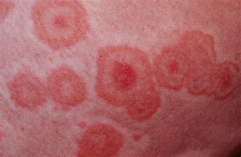 Erythema Multiforme Causes Symptoms Treatment