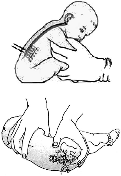 Lumbar Puncture Baby