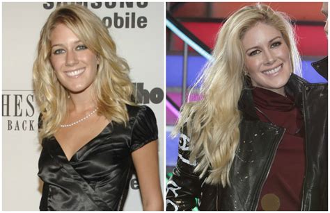 Heidi Montag Before And After Pics See Her Plastic Surgery Transformation