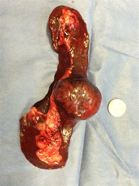 It depends how long your dog has had the cancer and if it has spread from the spleen to other parts of the body. Fatty spleen removed from blue-eyed beauty | Dr Phil ...