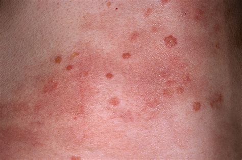 Hiv Rash Picturetypes And Home Treatment