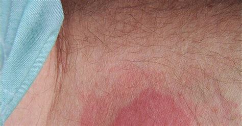 Bed Bug Rash Symptoms Treatment Causes