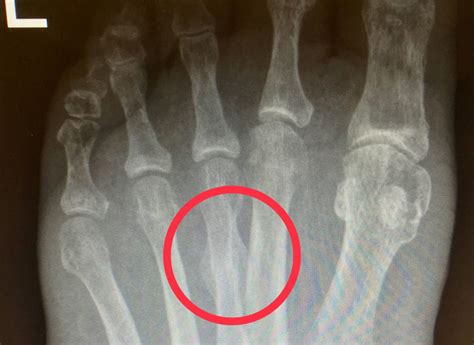 Stress Fractures Kann Foot Surgery Baddow Hospital Essex