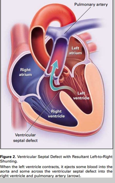 This terminology is used both for the abnormal state in humans and for normal physiological shunts in reptiles. ventricular septal defect with Left to Right shunting ...