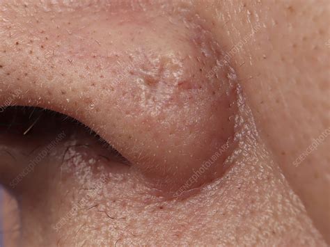 Basal Cell Carcinoma Of The Nasal Wing Stock Image C0507421