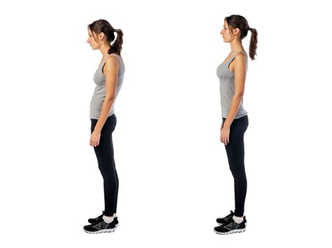 Swayback Posture Risks And Treatment
