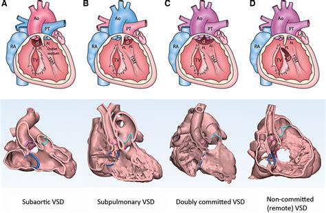 Essential Modifiers Of Double Outlet Right Ventricle Circulation