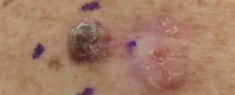 Squamous Cell Carcinoma Wikiwand