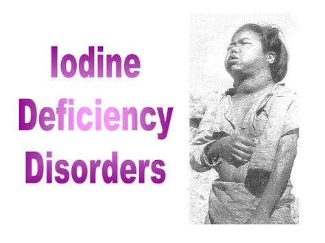 Ppt Iodine Deficiency Disorders Powerpoint Presentation Free