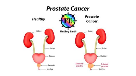 Who prostate cancer