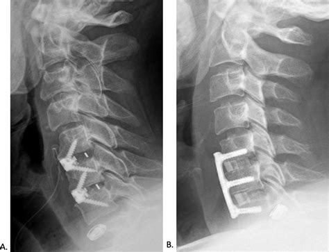2 Level Anterior Cervical Arthrodesis With Integrated Spacer And Plate