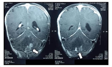 An Ill Defined Hypodense Lesion Arrows With Mild Peripheral Patchy