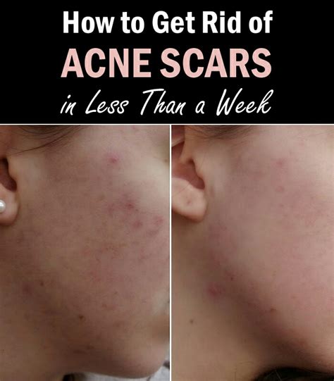 How To Get Rid Of Acne Scars In Less Than A Week Musely