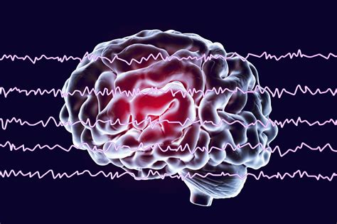 Mappatura cerebrale qEEG - Che cos'è? | APEX Brain Centers | Asheville