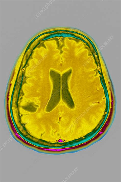 Cerebral Atrophy Mri Stock Image C0268791 Science Photo Library