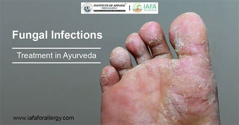 How To Treat Fungal Infections In Ayurveda