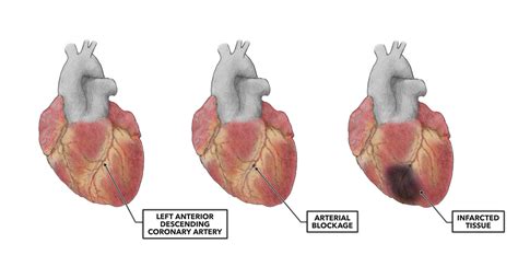 Crossfit The Heart Part Myocardial Infarction
