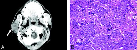 Cns Metastases Of Carcinoma Ex Pleomorphic Adenoma Of The Parotid Gland