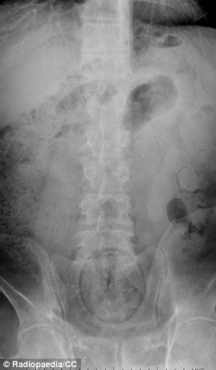 Doctors Share X Rays Of The Strangest Things Theyve Found Stuck In