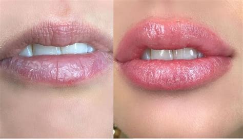 Lip Tattooing Before And After