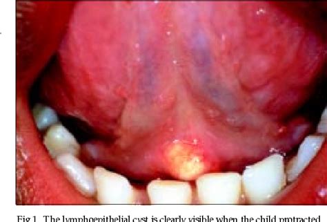 Pdf Oral Lymphoepithelial Cyst In A Young Child Semantic Scholar