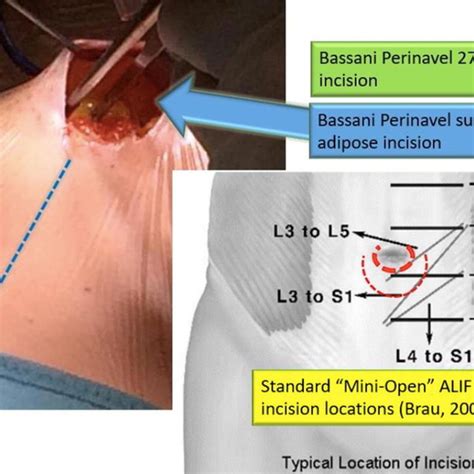Post Op X Ray A And Clinical Picture Of The Skin Incision At Year Download Scientific
