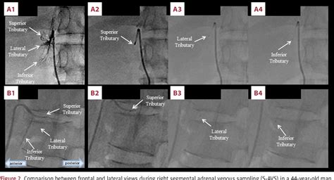 Figure From A Case Of Primary Aldosteronism Due To A Primary Adrenal