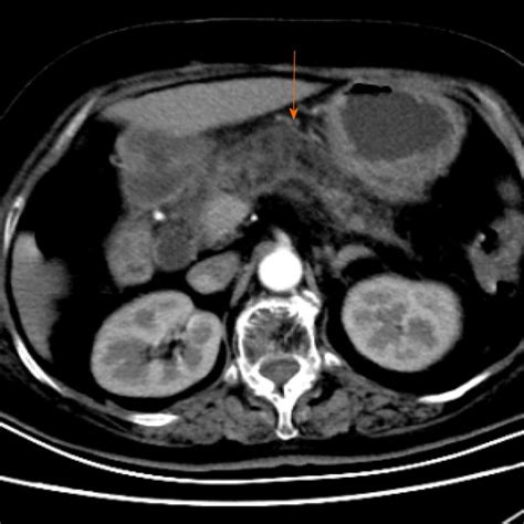 Abdominal Computed Tomography Revealed Mild Inflammation Of The