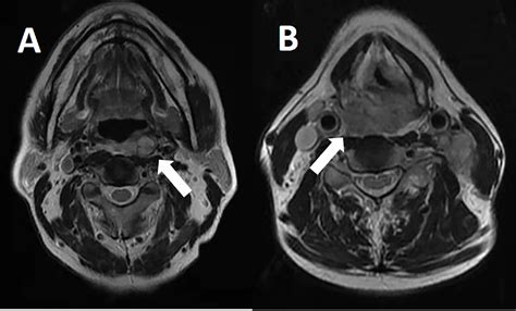 Figure 1 From Retropharyngeal Lymph Node Metastasis Diagnosed By