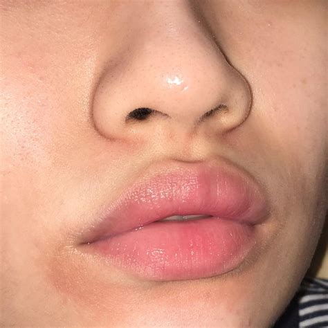 Skin Concerns Hi Ive Had This Dark Patch Around My Mouth For About A