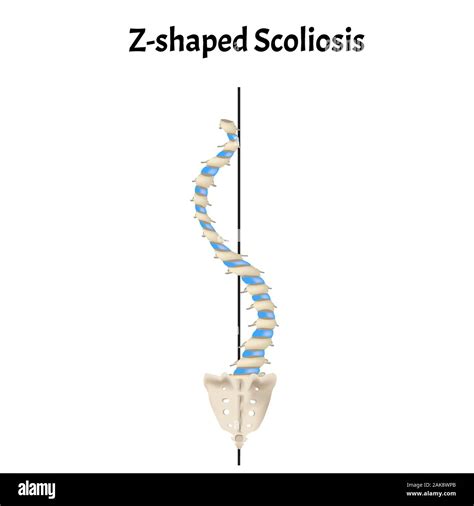 Z Shaped Scoliosis Dextroscoliosis Levoscoliosis Spinal Curvature