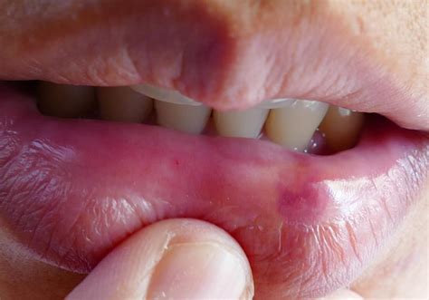 swollen bottom lip causes for no reason treatment of lower lips swelling american celiac