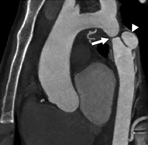 Ct And Mri Of Aortic Coarctation Pre And Postsurgical Findings Ajr