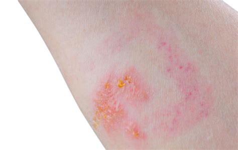 10 Common Types Of Skin Rashes You Should Be Aware Of