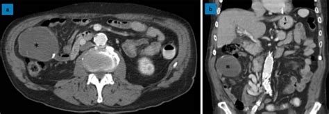 Large Cystic Mass In The Right Abdomen A Transverse Section Of The