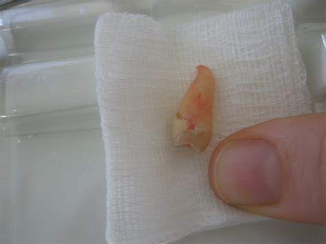 Wisdom Tooth Perspective Wisdom Tooth With Thumb For Pers Flickr