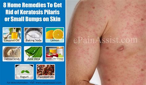 8 Home Remedies To Get Rid Of Keratosis Pilaris Or Small Bumps On Skin