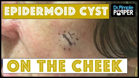Epidermoid Cyst Excision On Left Cheek Youtube Pimplesremedies