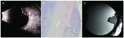 83 Year Old Patient With Choroidal Melanoma Infiltrating The