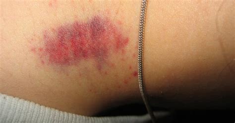Have you felt embarrassed in public because of your hickey mark? How to Remove a Hickey?