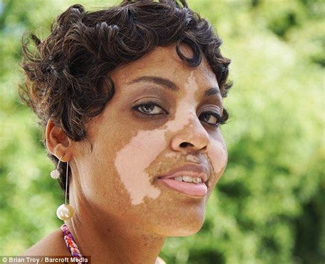 Woman Suffering From Vitiligo Says Condition Makes Her More Attractive