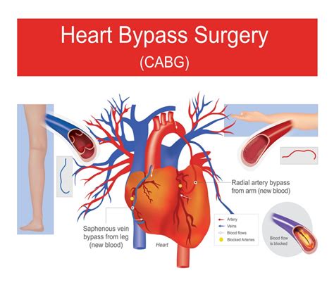 Heart Bypass Surgery Pictures