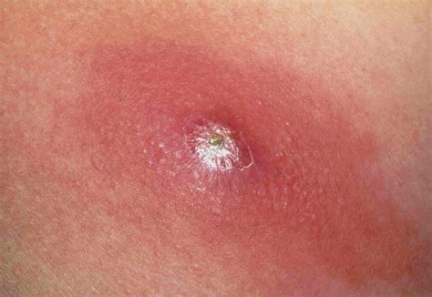 Causes Symptoms And Treatment Of Skin Boils